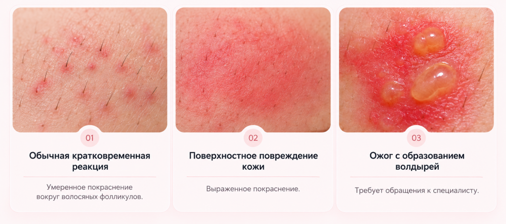 Сравнение реакций кожи после удаления волос.png